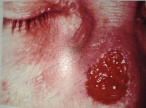 tertiary syphilis